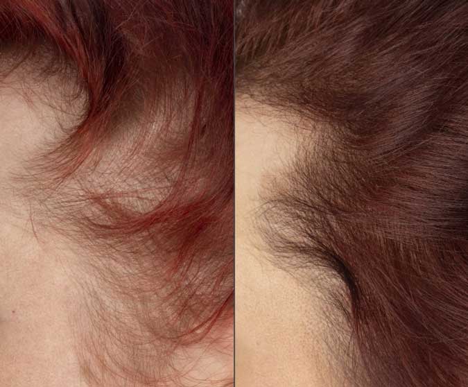 Close up of before and after image of red haired woman with thin hair and hair growth results over 16 weeks. 