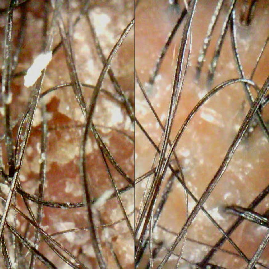 Before and after close-up shot of flakey scalp and a clean scalp. 