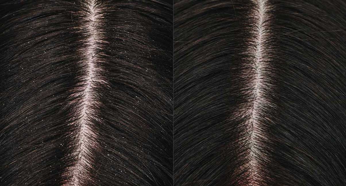 Before and after image of a close up flakey scalp to the left and clean scalp to the right. 