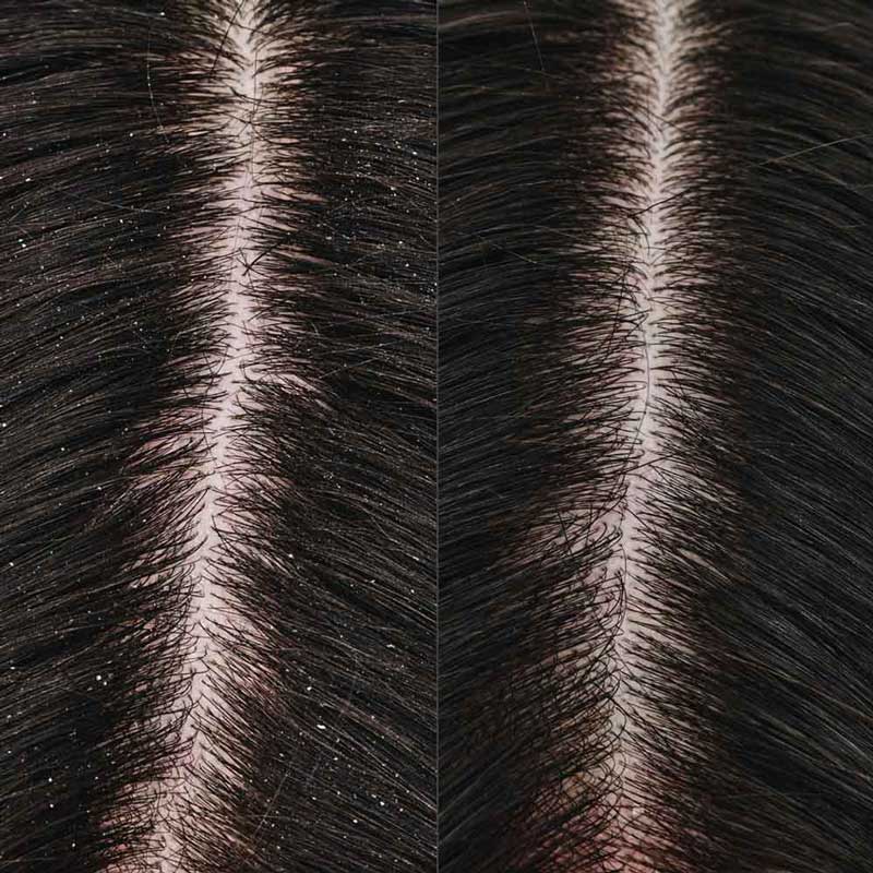 Before and after image of a close up flakey scalp to the left and clean scalp to the right. 
