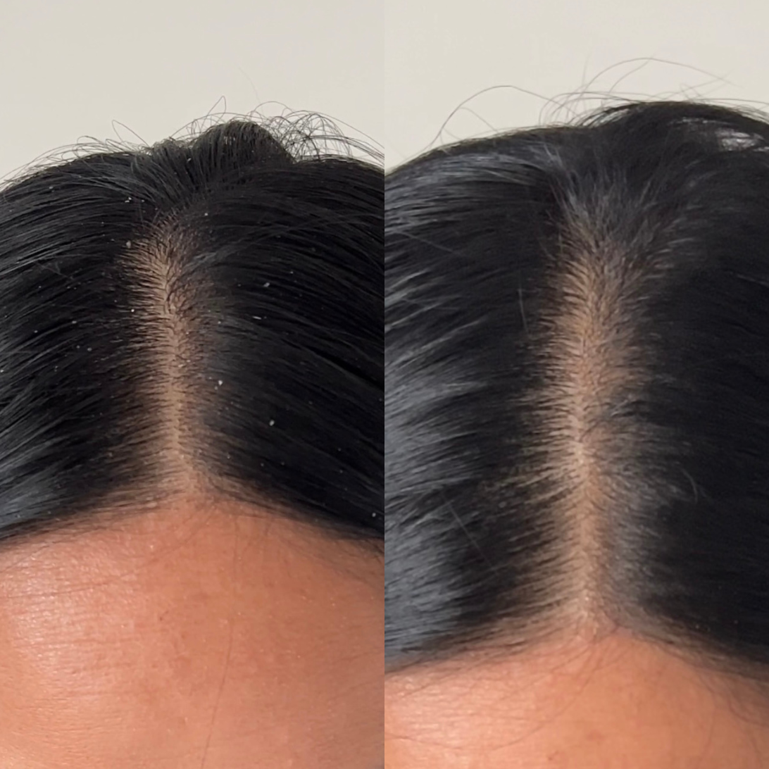 Before and after close-up shot of flakey scalp and a clean scalp. 